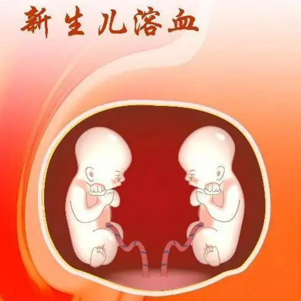 新生儿溶血症
