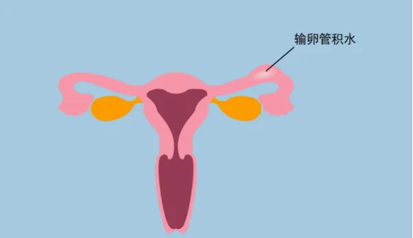 输卵管积液