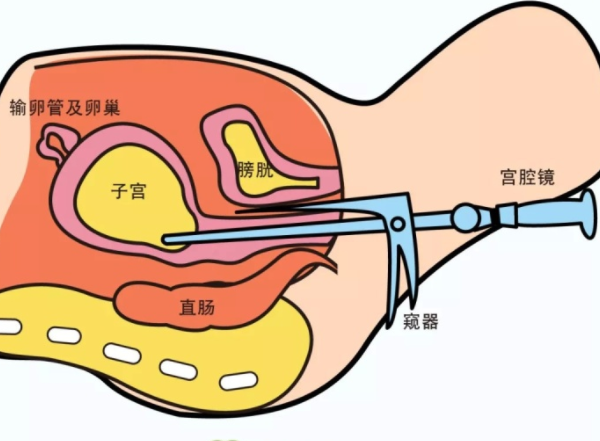 宫腔镜