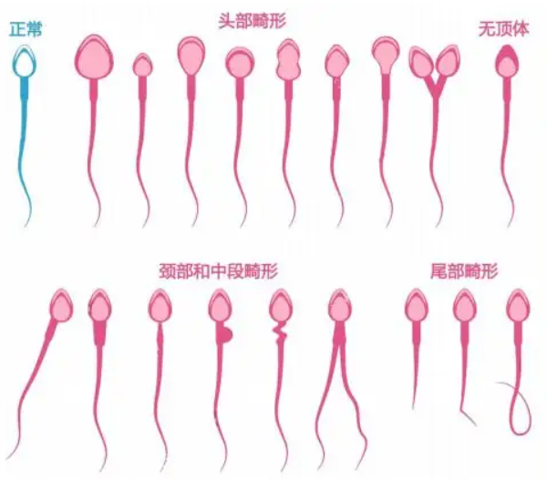 男性精子畸形