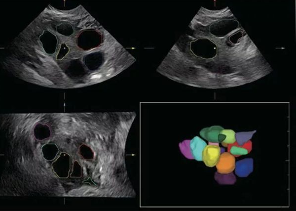 B超检测取卵