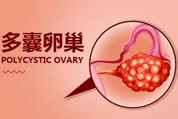 多囊卵巢综合征