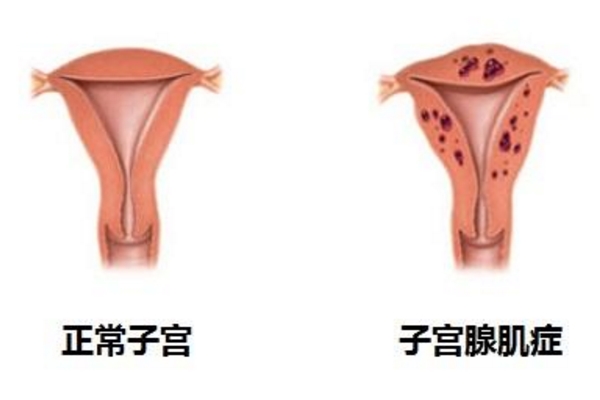 子宫腺肌病
