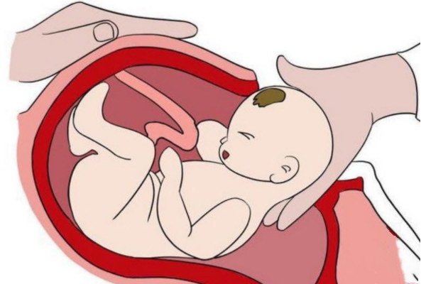 剖腹产
