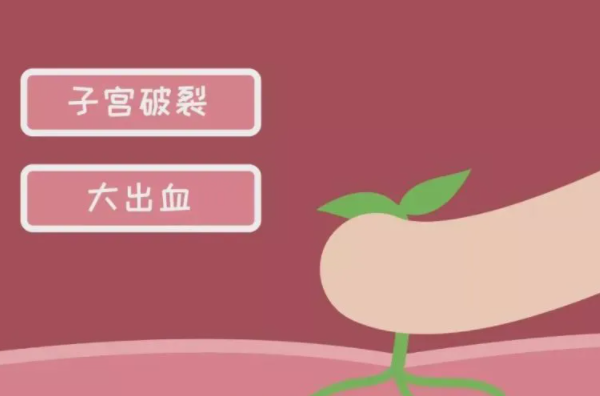 子宫破裂 大出血