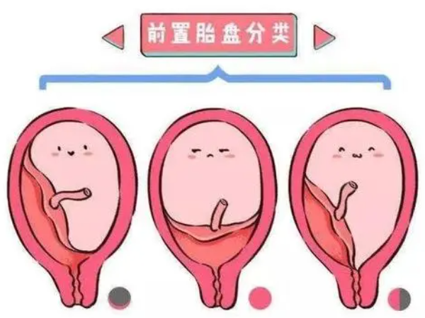 胎盘前置
