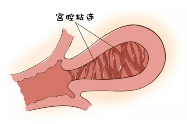 宫腔粘连