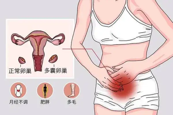 女性多囊卵巢综合征