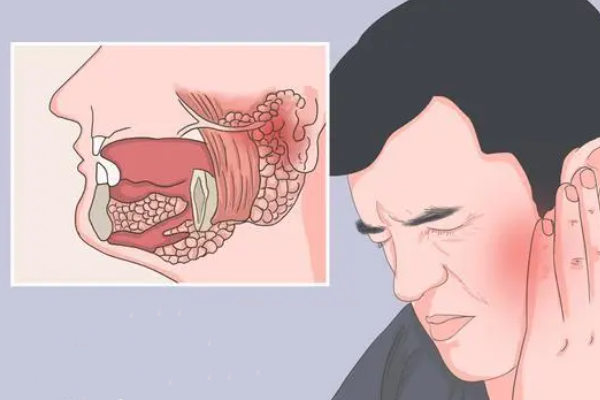 腮腺炎