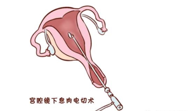 子宫内膜息肉