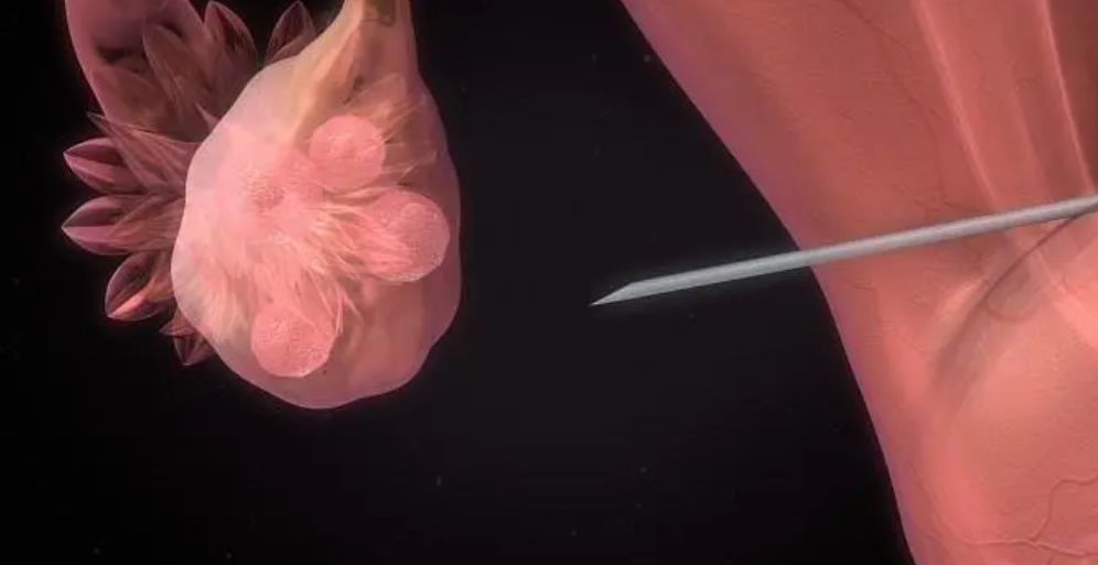 试管取卵