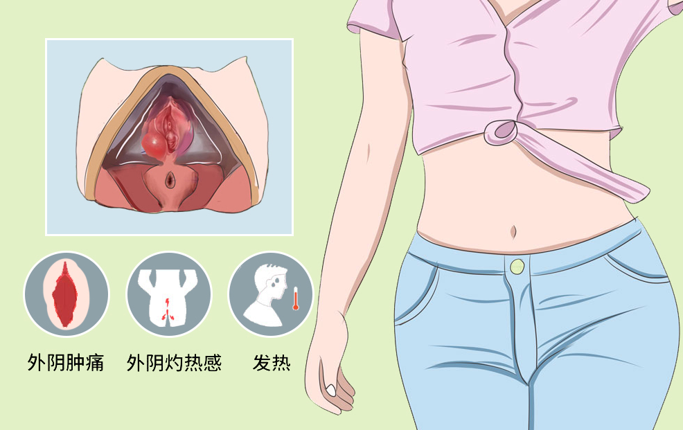 前庭大腺囊肿