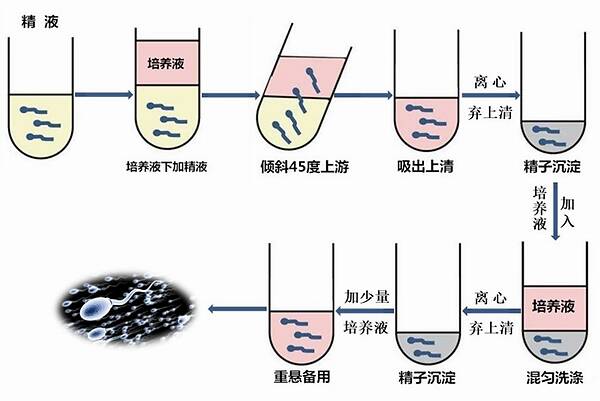  洗涤精子