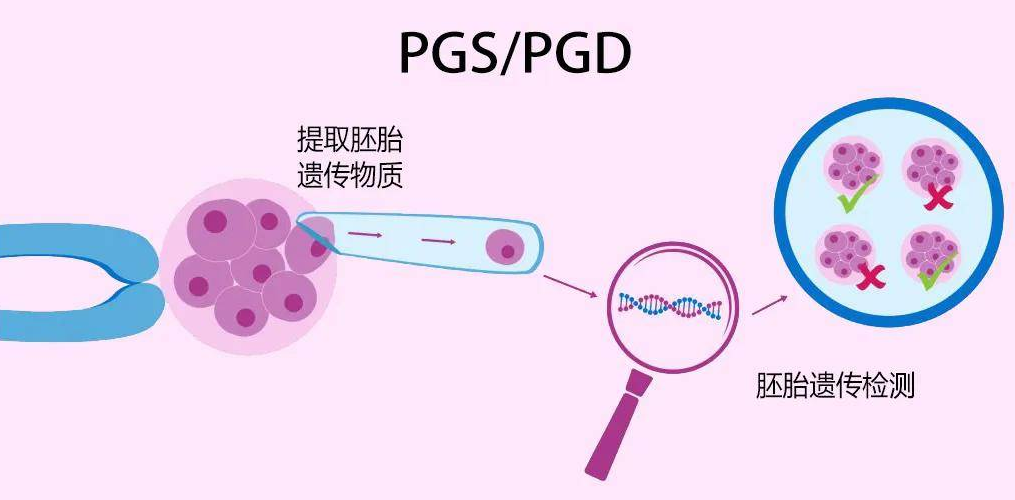 挑选囊胚移植