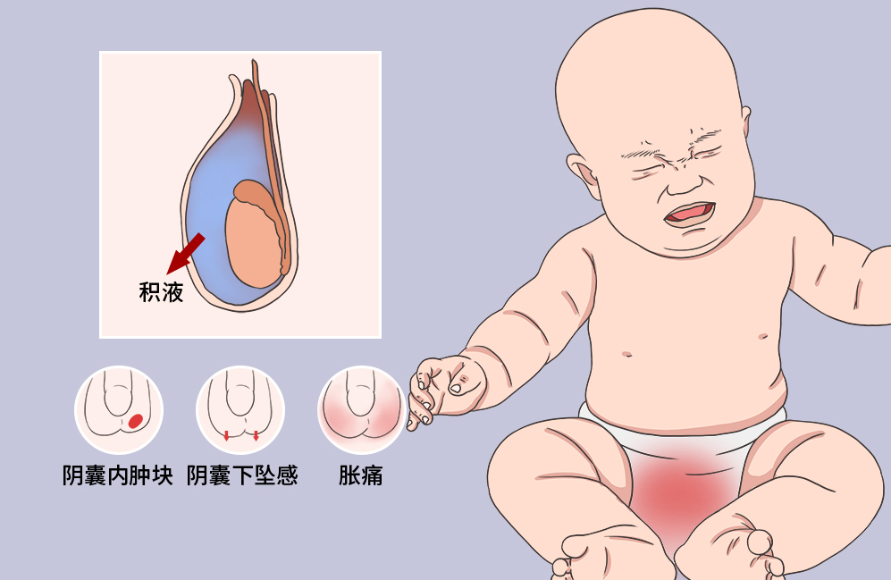 鞘膜积液