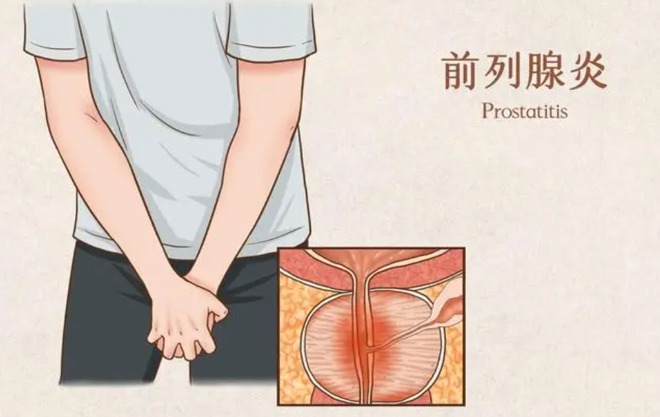 男性前列腺炎