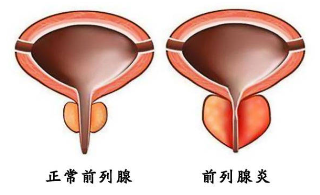 前列腺炎5