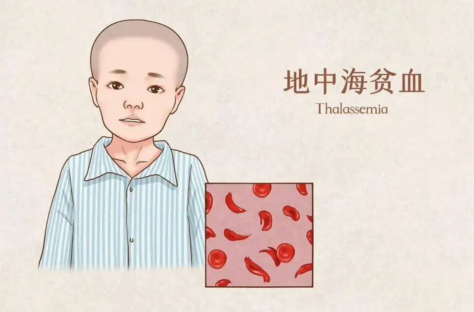 地中海贫血