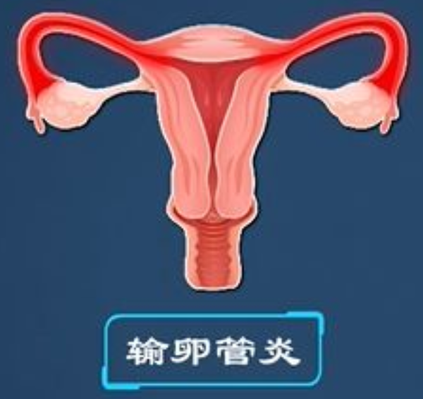 输卵管炎症