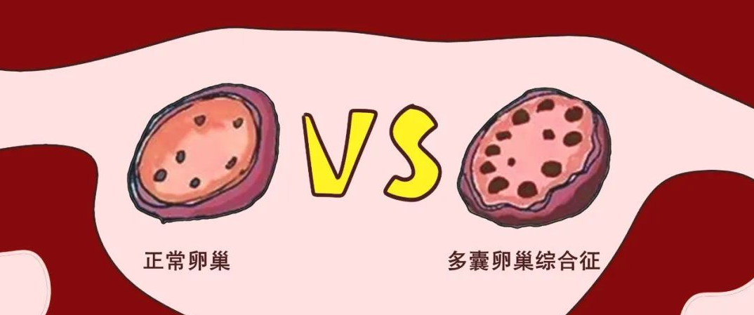 卵巢与多囊卵巢对比