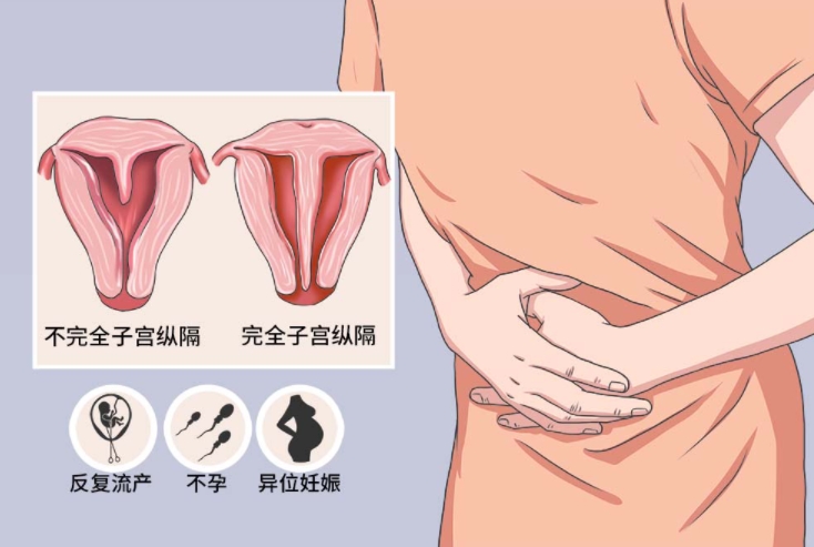 美国试管婴儿子宫纵膈