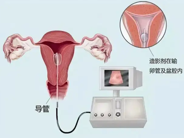 超声造影