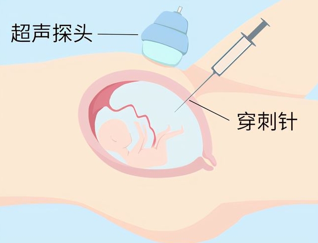 羊膜穿刺