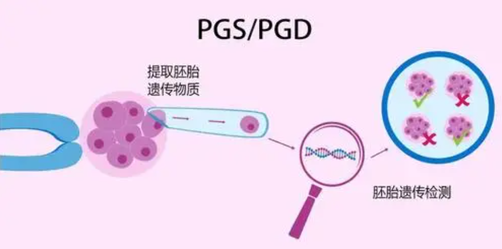 第三代试管婴儿技术