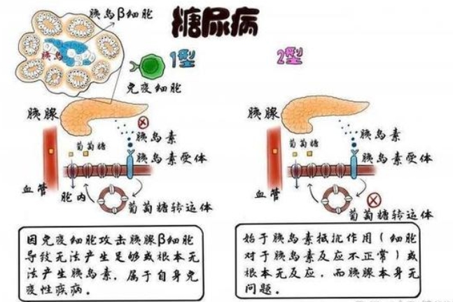 糖尿病12型