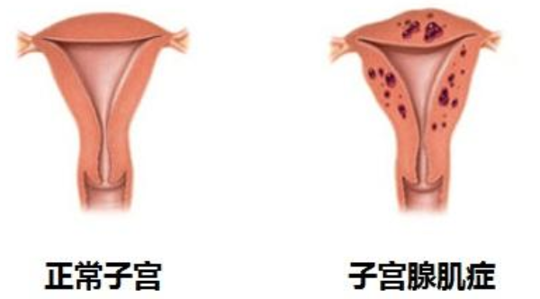 子宫腺肌症