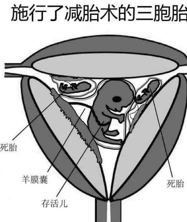 减胎术