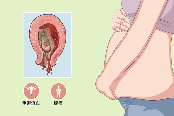自然流产
