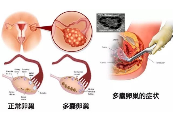 多囊卵巢