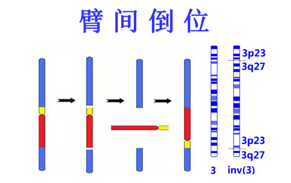 染色体平衡易位