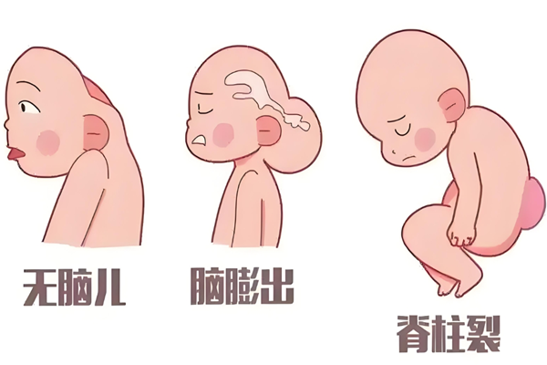 缺陷儿