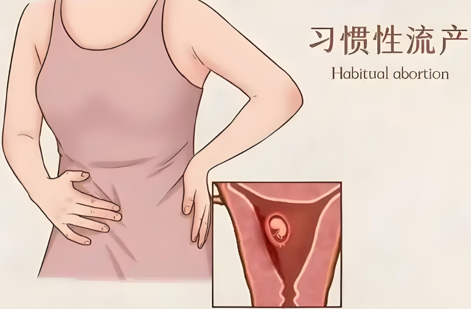 反复流产胎停