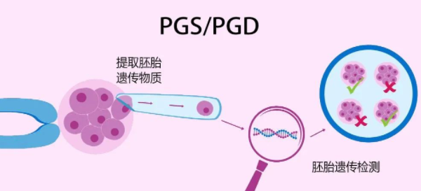 第三代试管婴儿技术