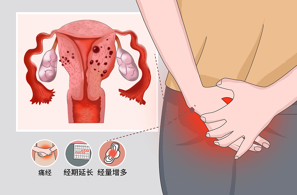 子宫腺肌症