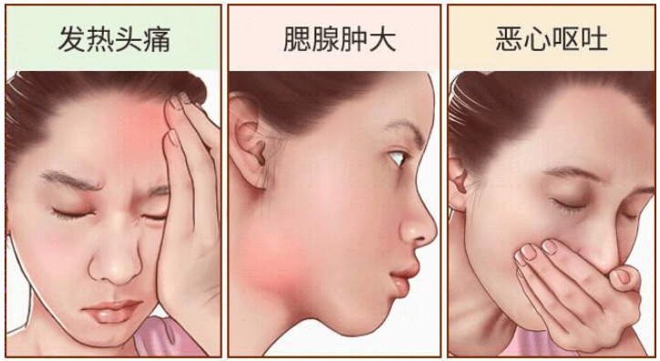 女性腮腺炎