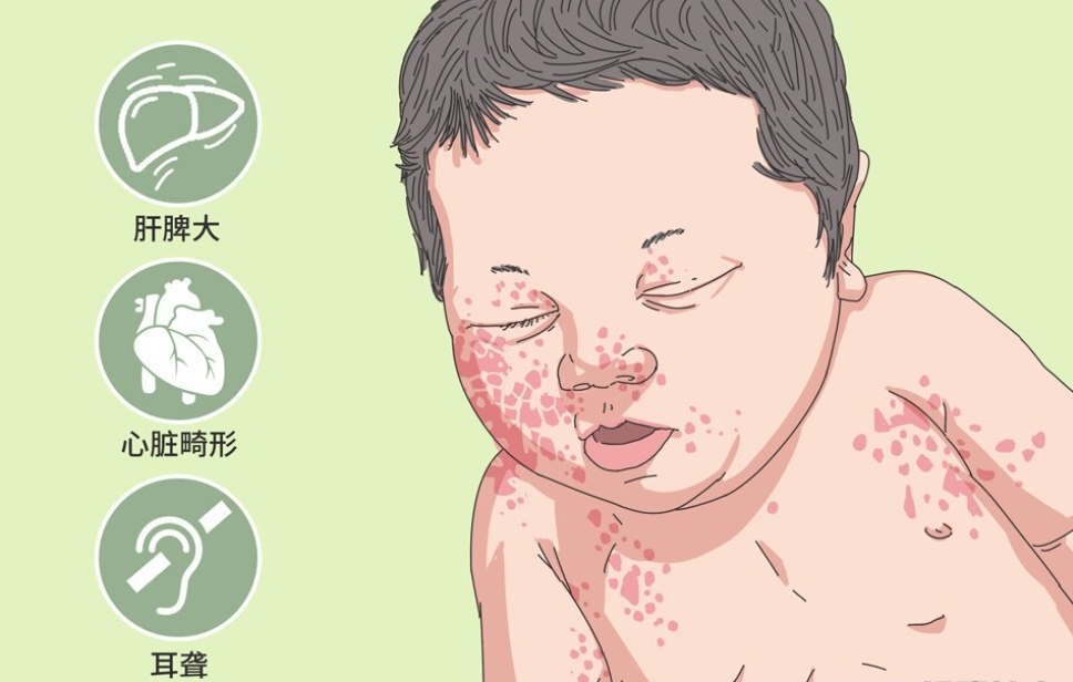 风疹综合征