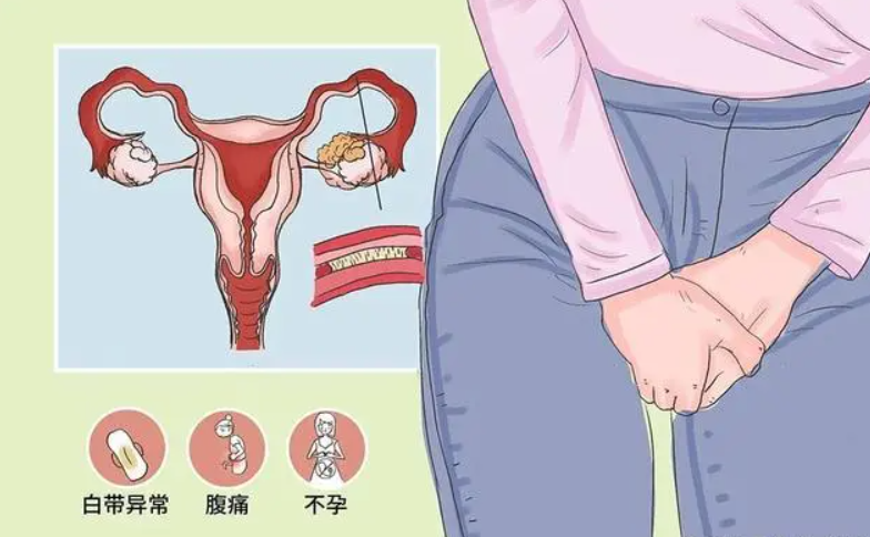 输卵管堵塞