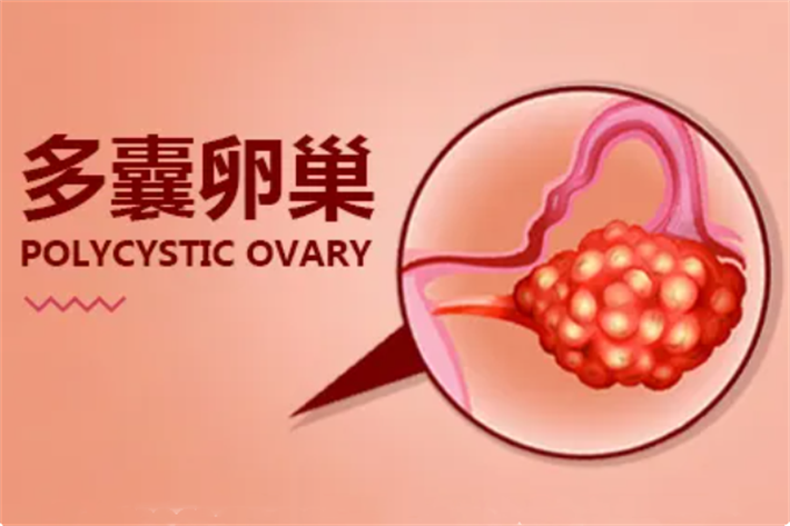 多囊卵巢33.png