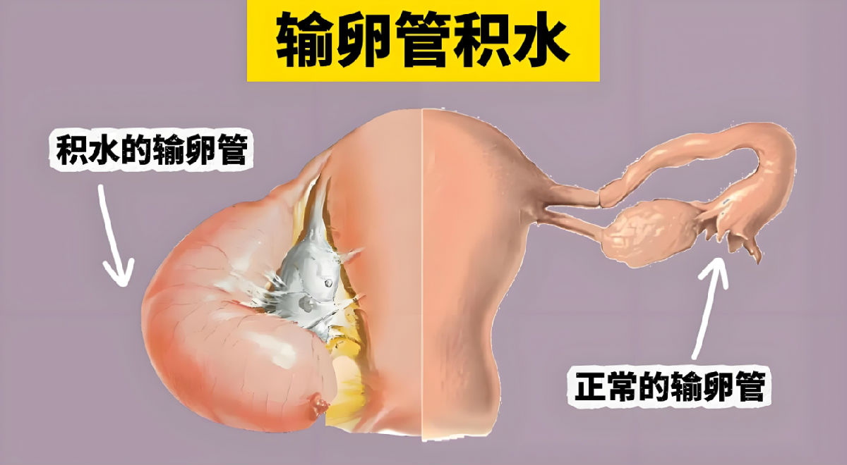 输卵管积水