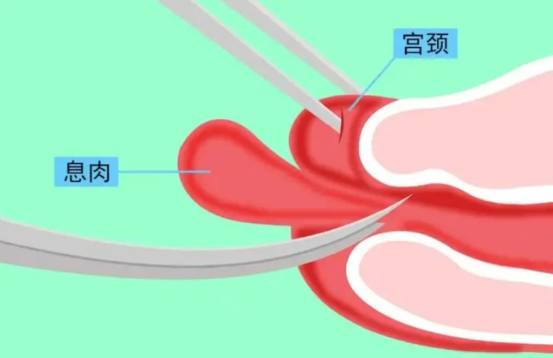 息肉手术