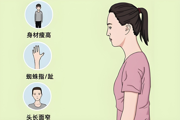 马凡氏综合征