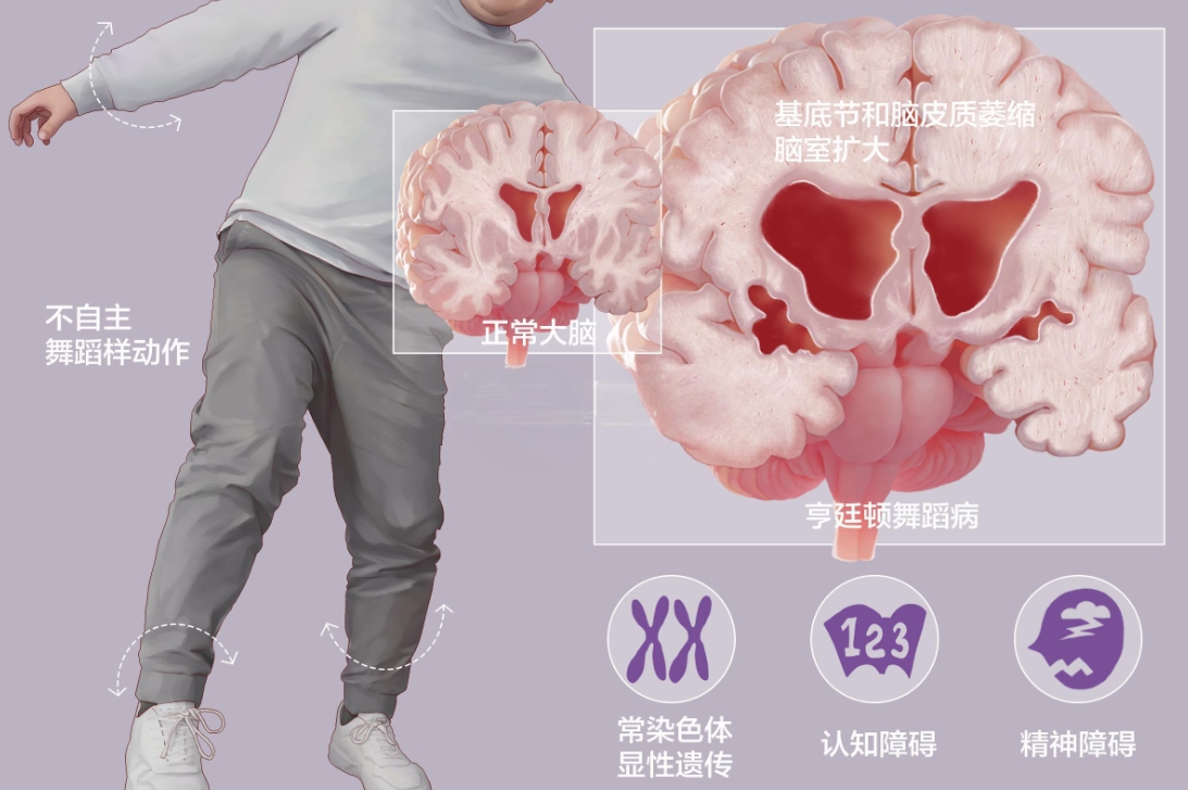 亨廷顿舞蹈症