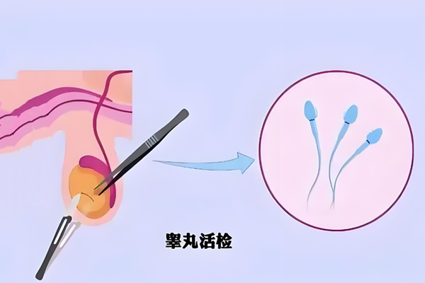睾丸活检