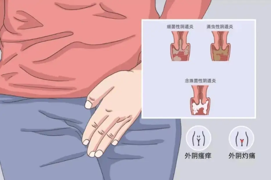 阴道炎2.png