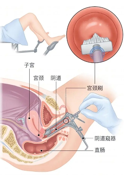 阴道镜检查