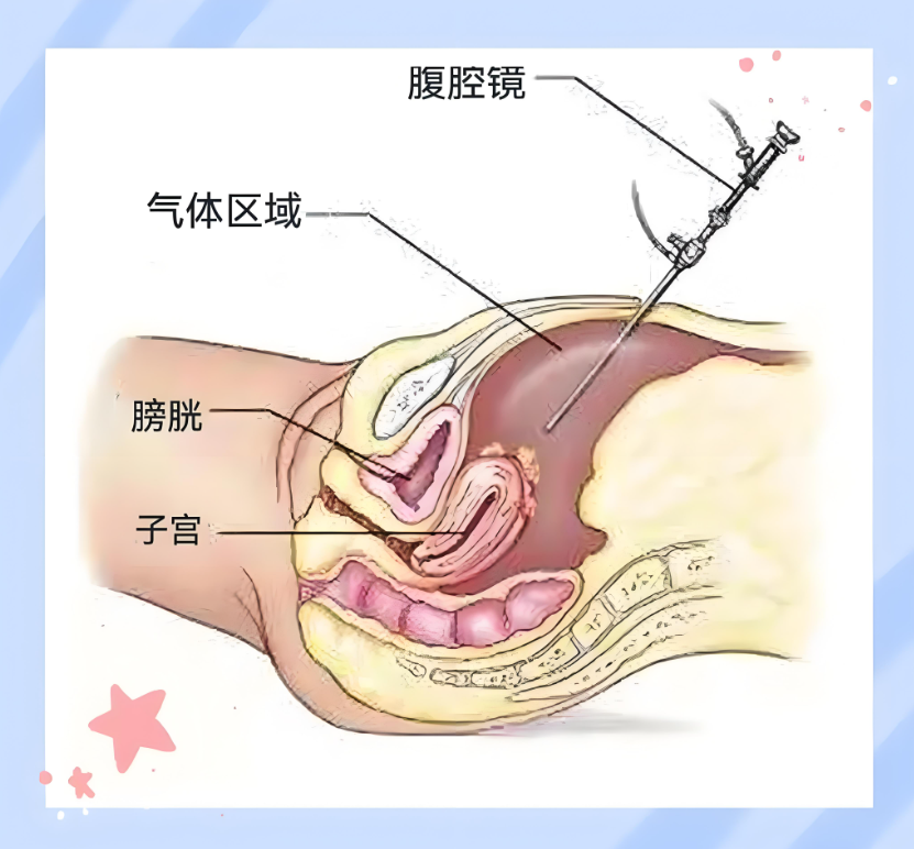 腹腔镜检查